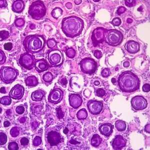 Psammoma body
