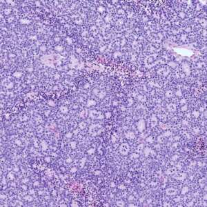 Retinoblastoma