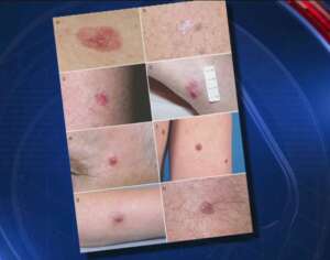 amelanotic melanoma