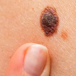 melanoma