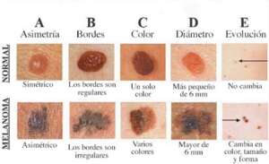 melanoma comparision picture