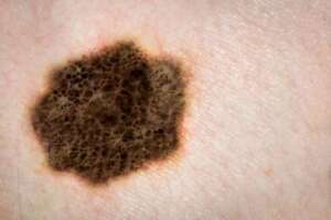 melanoma picture in the body