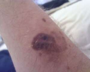 melanoma picture on arm
