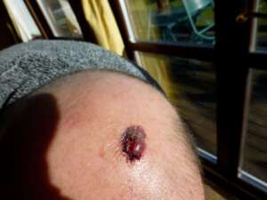 melanoma picture on the knee