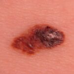 Melanoma Pictures Free Download