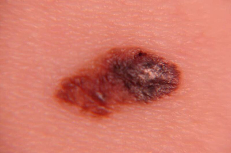 Melanoma Pictures