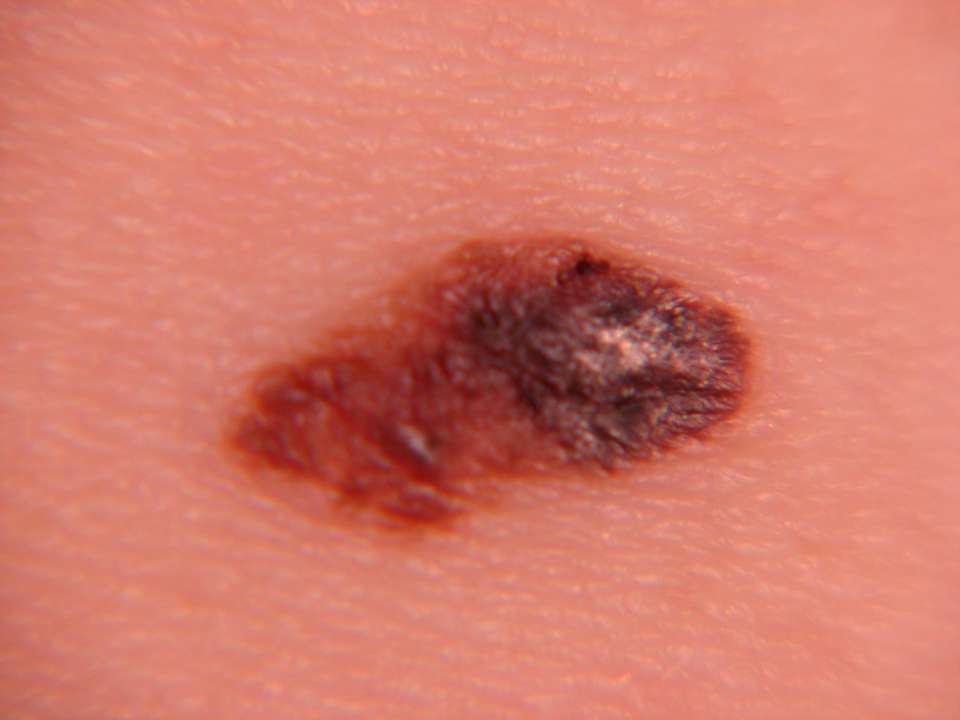 melanoma picture on the skin