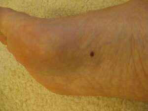 melanoma picture under the feet
